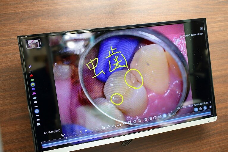 患者様と相談しながら最適な虫歯治療を行います。