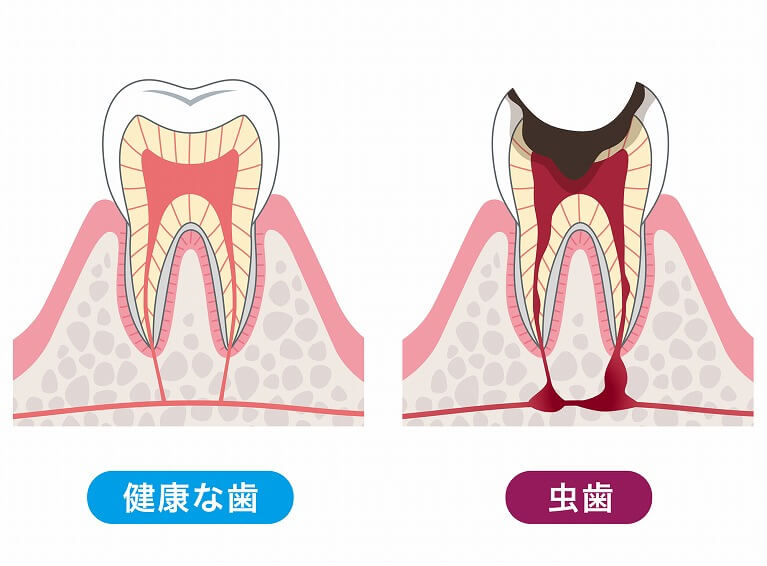 むし歯の早期対処には精密な検査が欠かせません